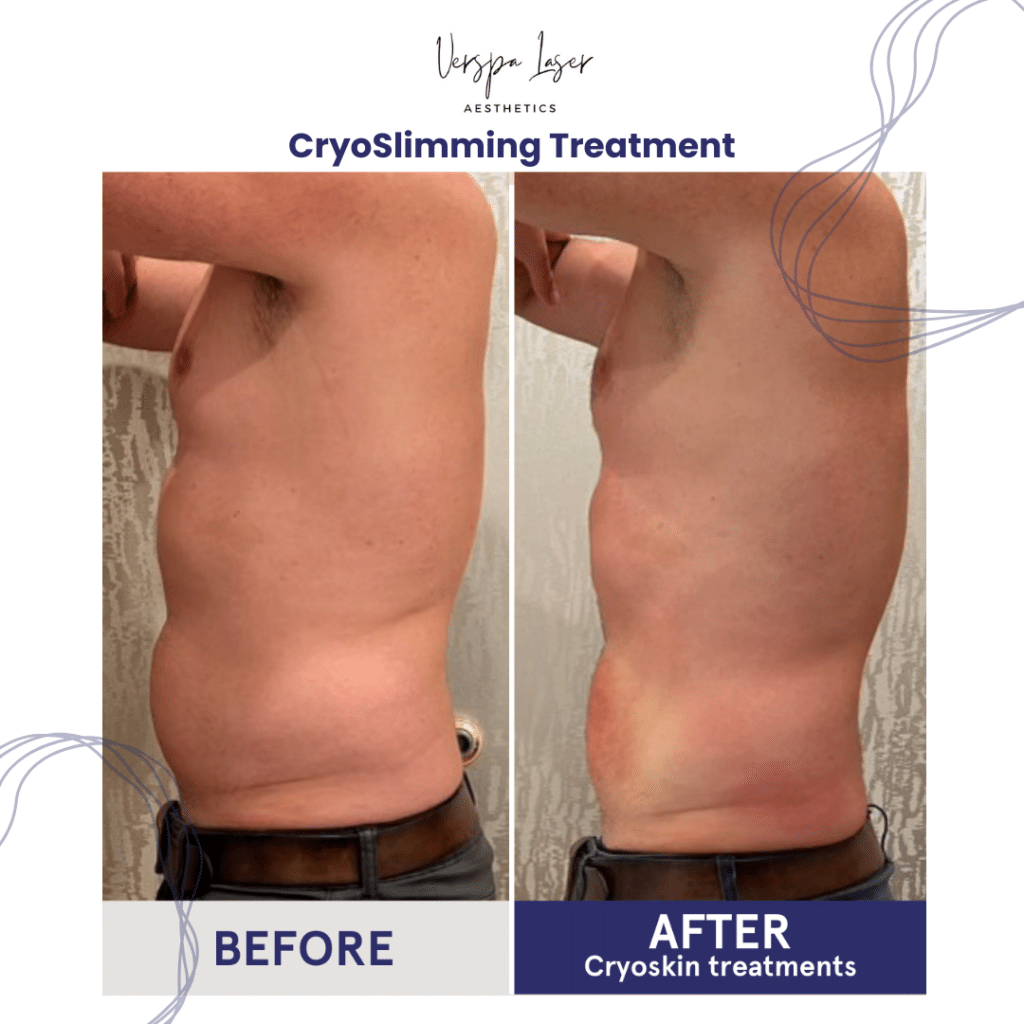 Cryo Slimming Weight Loss Fat Loss Med Spa New York - Verspa Laser Aesthetics Medical Spa in NY