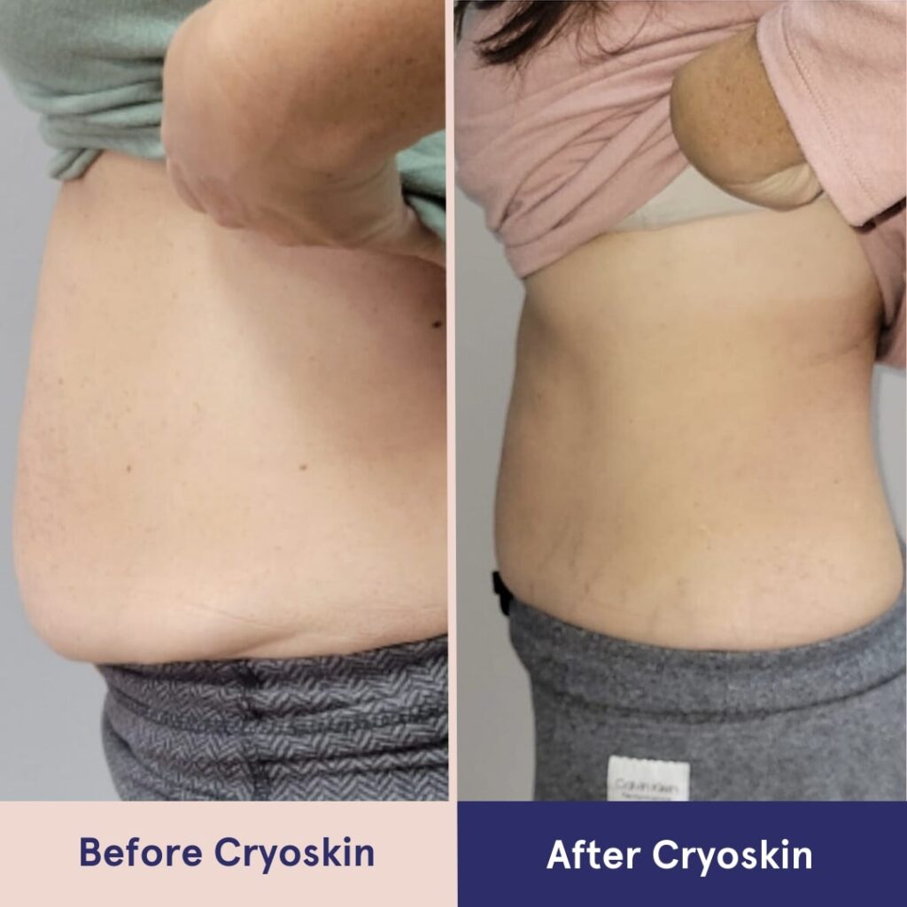 Cryotoning Body Sculpting Body Contouring Weight Loss Fat Loss Med Spa in NY - Verspa Laser Aesthetic a Medical Spa in New York