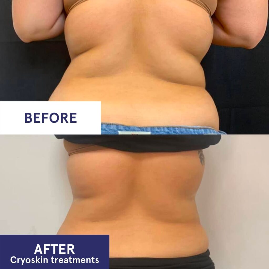 Cryotoning Body Sculpting Body Contouring Weight Loss Fat Loss Med Spa in NY - Verspa Laser Aesthetic a Medical Spa in New York