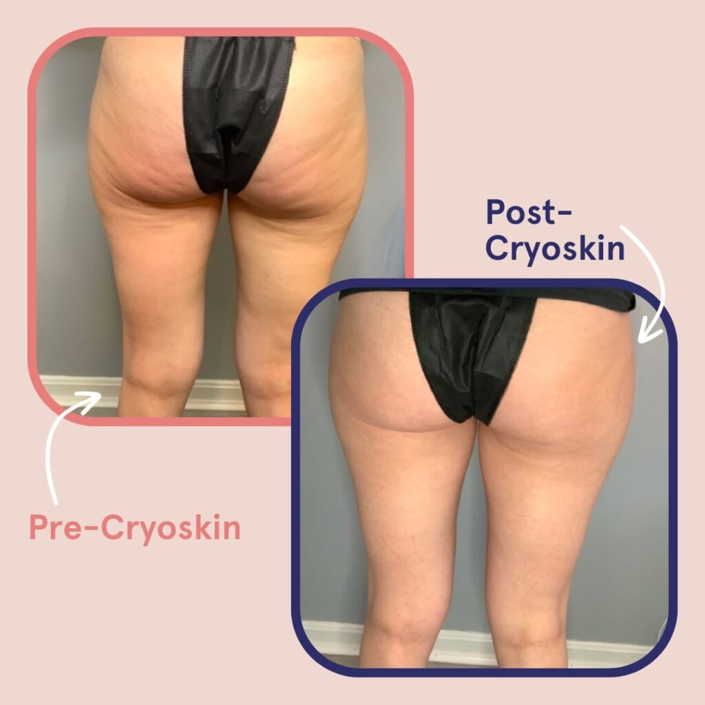 Cryotoning Body Sculpting Body Contouring Weight Loss Fat Loss Med Spa in NY - Verspa Laser Aesthetic a Medical Spa in New York